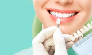 Benefits of Veneers