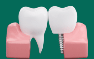 do gums grow back after implants