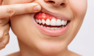 gum disease watford